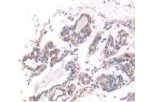 IHC-P analysis of Human Breast Cancer Tissue, with DAB staining. (IFNA5 Antikörper  (AA 22-189))