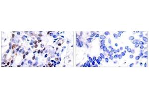 Immunohistochemical analysis of paraffin-embedded human breast carcinoma tissue using c-Jun (Ab-91) antibody (E021021). (C-JUN Antikörper)