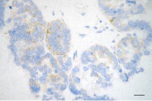Immunohistochemistry was performed on paraffin-embedded human ovarian carcinoma using MSI2 antibody (ABIN7799495), 1:200). (Rekombinanter MSI2 Antikörper)