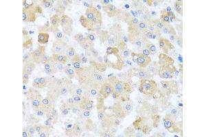 Immunohistochemistry of paraffin-embedded Human liver damage using CETN1 Polyclonal Antibody at dilution of 1:100 (40x lens). (Centrin 1 Antikörper)