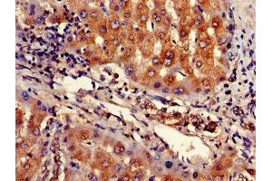 Immunohistochemistry of paraffin-embedded human liver cancer using ABIN7167943 at dilution of 1:100