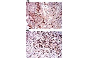 Immunohistochemical staining of human endometrial cancer tissues (A) and bladder cancer tissues (B) with CTNNBL1 monoclonal antibody, clone 1E4F5  at 1:200-1:1000 dilution. (CD68 Antikörper  (AA 42-155))