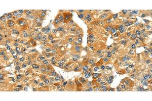Immunohistochemistry of paraffin-embedded Human liver cancer using SPARC Polyclonal Antibody at dilution of 1:35 (SPARC Antikörper)