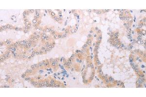 Immunohistochemistry of paraffin-embedded Human thyroid cancer tissue using TPO Polyclonal Antibody at dilution 1:50 (TPO Antikörper)