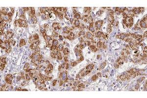 ABIN6278496 at 1/100 staining Human liver cancer tissue by IHC-P. (GRIN2C Antikörper  (Internal Region))