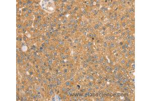 Immunohistochemistry of Human breast cancer using SNX2 Polyclonal Antibody at dilution of 1:40 (Sorting Nexin 2 Antikörper)