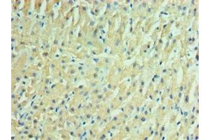 Immunohistochemistry of paraffin-embedded human liver cancer using ABIN7157125 at dilution of 1:100 (IDH2 Antikörper  (AA 193-452))