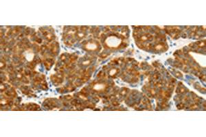 Immunohistochemistry of paraffin-embedded Human thyroid cancer tissue using VEGFB Polyclonal Antibody at dilution of 1:25(x200) (VEGFB Antikörper)