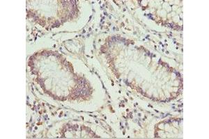 Immunohistochemistry of paraffin-embedded human colon cancer using ABIN7151499 at dilution of 1:100 (ETFA Antikörper  (AA 1-333))