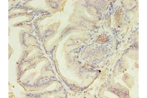 Immunohistochemistry of paraffin-embedded human prostate cancer using ABIN7176718 at dilution of 1:100 (AZGP1 Antikörper  (AA 61-210))