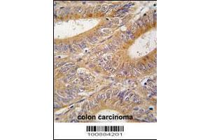 Formalin-fixed and paraffin-embedded human colon carcinoma tissue reacted with AIK antibody , which was peroxidase-conjugated to the secondary antibody, followed by DAB staining. (Aurora A Antikörper  (N-Term))