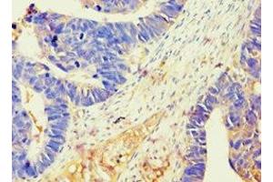 Immunohistochemistry of paraffin-embedded human ovarian cancer using ABIN7145213 at dilution of 1:100 (BAG2 Antikörper  (AA 1-211))