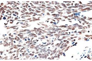 Immunohistochemistry of paraffin-embedded Human lung cancer using AQR Polyclonal Antibody at dilution of 1:100 (40x lens). (AQR Antikörper)