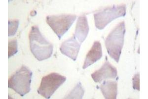 Immunohistochemistry analyzes of PP1α (G315) antibody in paraffin-embedded human breast carcinoma tissue. (CRYAB Antikörper)