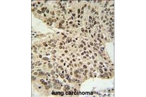 HIST1H2AL Antibody (C-term) (ABIN651090 and ABIN2840066) IHC analysis in formalin fixed and paraffin embedded human lung carcinoma followed by peroxidase conjugation of the secondary antibody and DAB staining. (HIST1H2AL Antikörper  (C-Term))