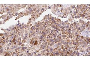 ABIN6273127 at 1/100 staining Human Melanoma tissue by IHC-P. (INHBA Antikörper  (Internal Region))