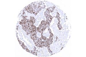 Merkel cell carcinoma with moderate to strong TdT immunostaining in _80 of tumor cells. (Rekombinanter TdT Antikörper)