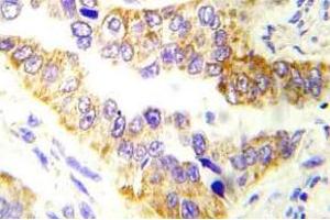 Immunohistochemistry (IHC) analyzes of Tsc2 antibody in paraffin-embedded human lung carcinoma tissue. (Tuberin Antikörper)
