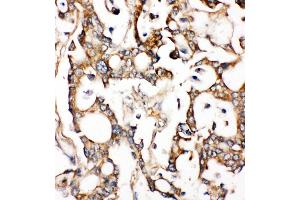 Anti-ALDH2 antibody, IHC(P) IHC(P): Human Liver Cancer Tissue (ALDH2 Antikörper  (N-Term))