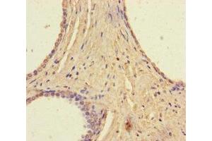 Immunohistochemistry of paraffin-embedded human prostate cancer using ABIN7168135 at dilution of 1:100 (RAVER2 Antikörper  (AA 2-691))