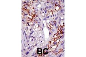 Formalin-fixed and paraffin-embedded human cancer tissue reacted with the primary antibody, which was peroxidase-conjugated to the secondary antibody, followed by DAB staining. (USP22 Antikörper  (C-Term))