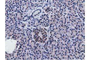 Immunohistochemical staining of paraffin-embedded Adenocarcinoma of Human breast tissue using anti-NT5DC1 mouse monoclonal antibody. (NT5DC1 Antikörper)