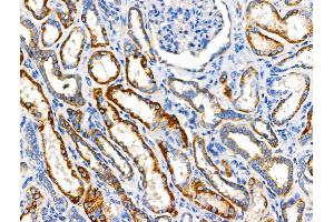 ABIN6258577 and ABIN6274797 at 1/100 staining Human kidney cancer and adjacent normal tissues by IHC-P. (ACAT1 Antikörper  (Internal Region))