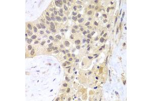 Immunohistochemistry of paraffin-embedded human lung cancer using PSMC5 antibody at dilution of 1:100 (400x lens). (PSMC5 Antikörper)