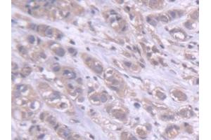 Detection of DARS in Human Breast cancer Tissue using Polyclonal Antibody to Aspartyl tRNA Synthetase (DARS) (DARS Antikörper  (AA 363-501))
