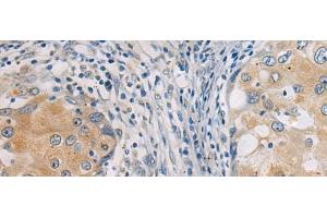Immunohistochemistry of paraffin-embedded Human breast cancer tissue using GBA Polyclonal Antibody at dilution of 1:55(x200) (GBA Antikörper)
