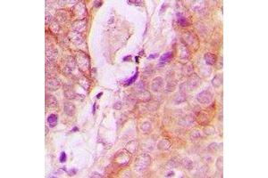Immunohistochemical analysis of RAB34 staining in human breast cancer formalin fixed paraffin embedded tissue section. (RAB34 Antikörper  (C-Term))