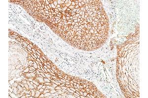 Immunohistochemistry (IHC) image for anti-Cadherin 1, Type 1, E-Cadherin (Epithelial) (CDH1) (AA 155-707) antibody (ABIN7455206)