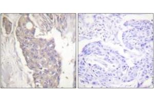 Immunohistochemistry analysis of paraffin-embedded human breast carcinoma tissue, using FAS Antibody. (FAS Antikörper  (AA 281-330))