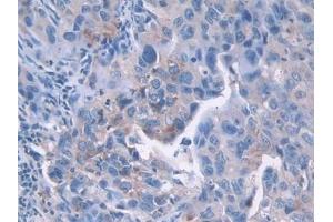Detection of CDK2 in Human Breast cancer Tissue using Polyclonal Antibody to Cyclin Dependent Kinase 2 (CDK2) (CDK2 Antikörper  (AA 94-198))