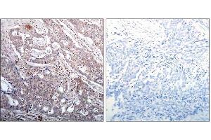 Immunohistochemical analysis of paraffin-embedded human breast carcinoma tissue, using IκB-β (Phospho-Ser23) antibody (E011304). (NFKBIB Antikörper  (pSer23))