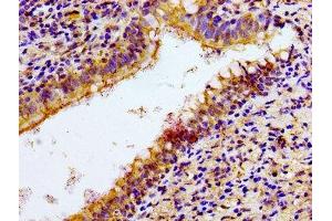 Immunohistochemistry of paraffin-embedded human lung cancer using ABIN7161080 at dilution of 1:100 (NCR3 Antikörper  (AA 19-135))