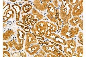 ABIN6260517 and ABIN6277589 at 1/100 staining Human kidney cancer and adjacent normal tissues by IHC-P. (CBR1 Antikörper  (C-Term))