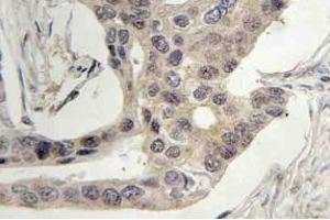 Immunohistochemistry (IHC) analyzes of SLP-76 antibody in paraffin-embedded human breast carcinoma tissue. (LCP2 Antikörper)