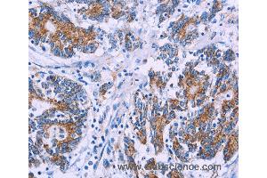 Immunohistochemistry of Human colon cancer using AGFG1 Polyclonal Antibody at dilution of 1:50 (AGFG1 Antikörper)