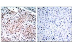Immunohistochemical analysis of paraffin-embedded human breast carcinoma tissue using Estrogen Receptor-a(Phospho-Ser104) Antibody(left) or the same antibody preincubated with blocking peptide(right). (Estrogen Receptor alpha Antikörper  (pSer104))