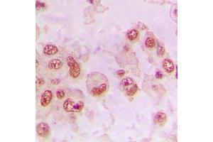 Immunohistochemical analysis of RAD23B staining in human lung cancer formalin fixed paraffin embedded tissue section. (RAD23B Antikörper  (N-Term))