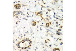 Immunohistochemistry of paraffin-embedded human liver cancer using NRBF2 antibody at dilution of 1:100 (x40 lens). (NRBF2 Antikörper)