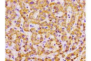 Immunohistochemistry of paraffin-embedded human liver cancer using ABIN7142326 at dilution of 1:100 (MPST Antikörper  (AA 102-208))