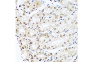 Immunohistochemistry of paraffin-embedded human gastric cancer using SNAI1 antibody. (SNAIL Antikörper)