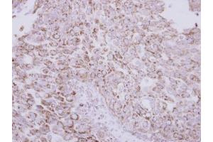 IHC-P Image Immunohistochemical analysis of paraffin-embedded human breast cancer, using Protein C, antibody at 1:250 dilution.