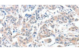 Immunohistochemistry of paraffin-embedded Human breast cancer using CD156c Polyclonal Antibody at dilution of 1:30