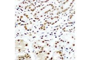 Immunohistochemical analysis of Pontin 52 staining in human gastric cancer formalin fixed paraffin embedded tissue section. (RUVBL1 Antikörper)
