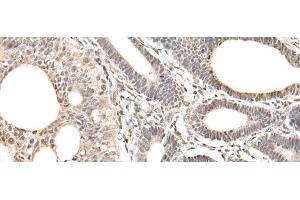 Immunohistochemistry of paraffin-embedded Human gastric cancer tissue using ZNF281 Polyclonal Antibody at dilution of 1:30(x200) (ZNF281 Antikörper)