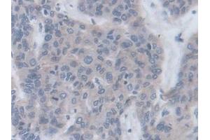 Detection of CRLF1 in Human Liver cancer Tissue using Polyclonal Antibody to Cytokine Receptor Like Factor 1 (CRLF1) (CRLF1 Antikörper  (AA 138-422))