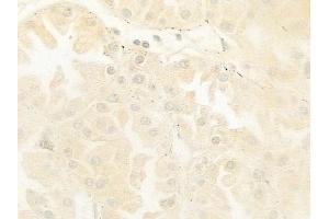 ABIN6264363 and ABIN6279003 at 1/100 staining human renal cell carcinoma by IHC-P.